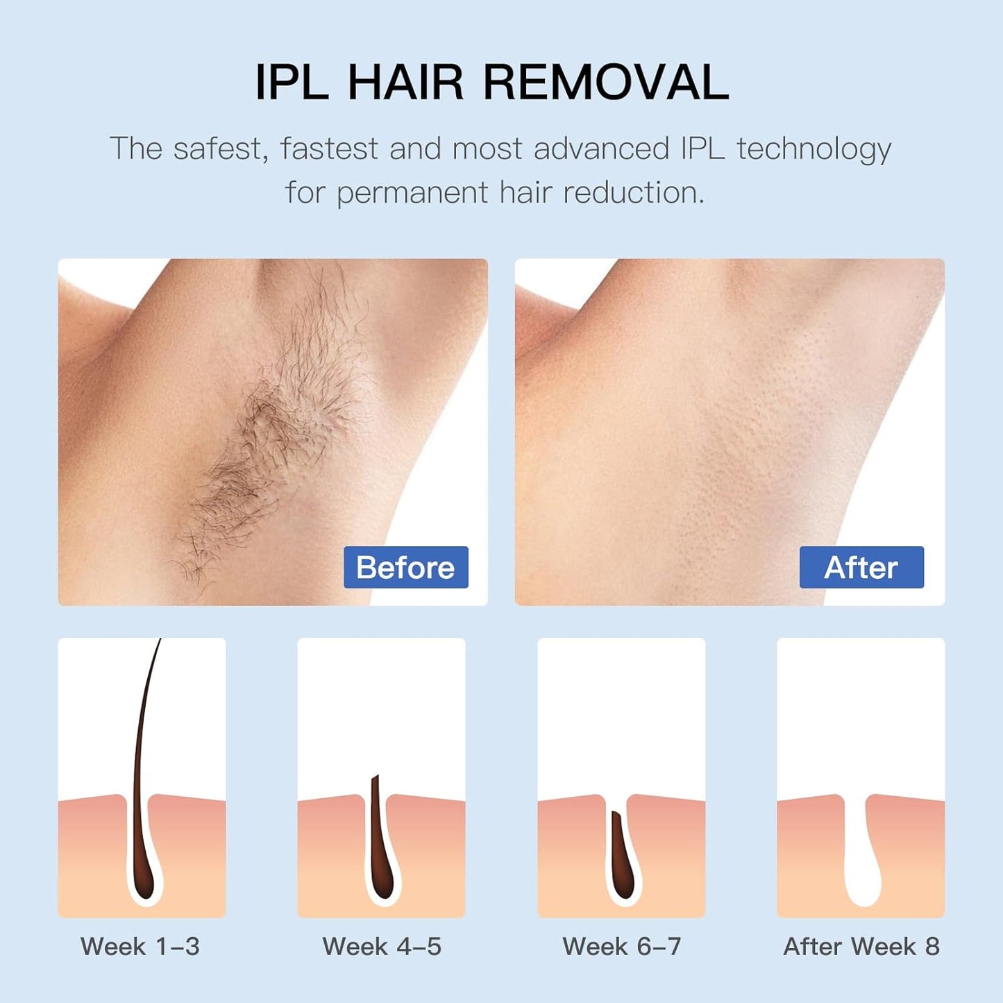 Mlay™ T17 Hair Removal Device