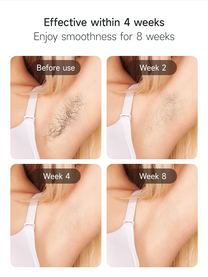 Mlay™ T18 Hair Removal Device
